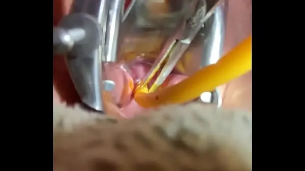 Tổng cộng Inserting Foley into cervix ống nóng